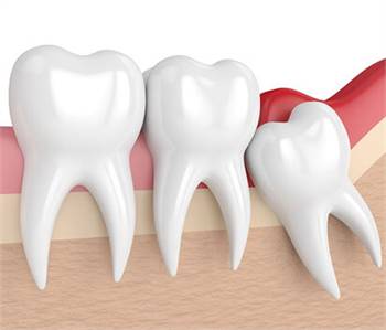  Keller Tooth Extraction